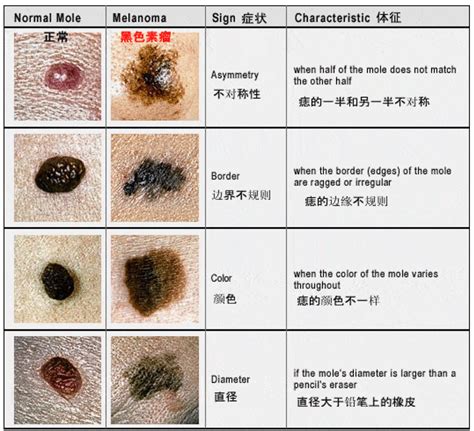 乳房上有痣|痣也可能会癌变！长在 3 个地方要注意